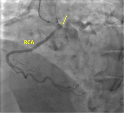 Transit time flow measurement guiding the surgical treatment for anomalous origin of the right coronary artery: A case report